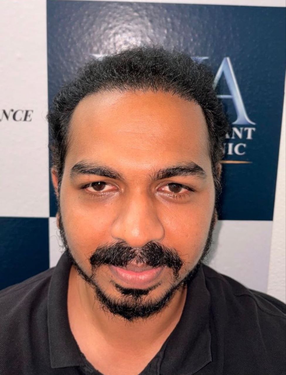 Hair restoration after treatment