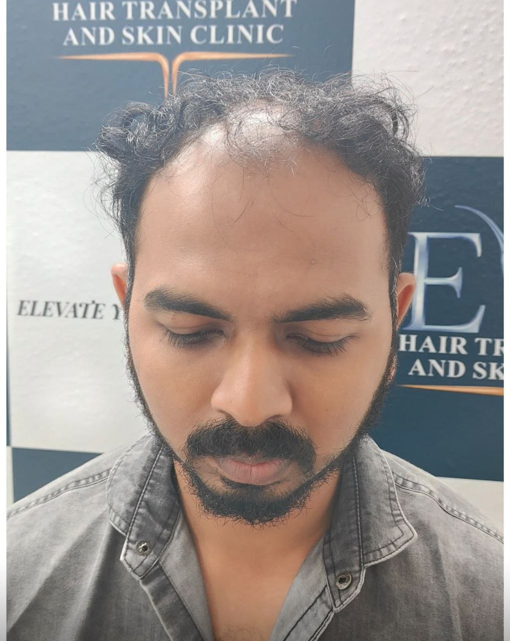 Hair restoration before treatment