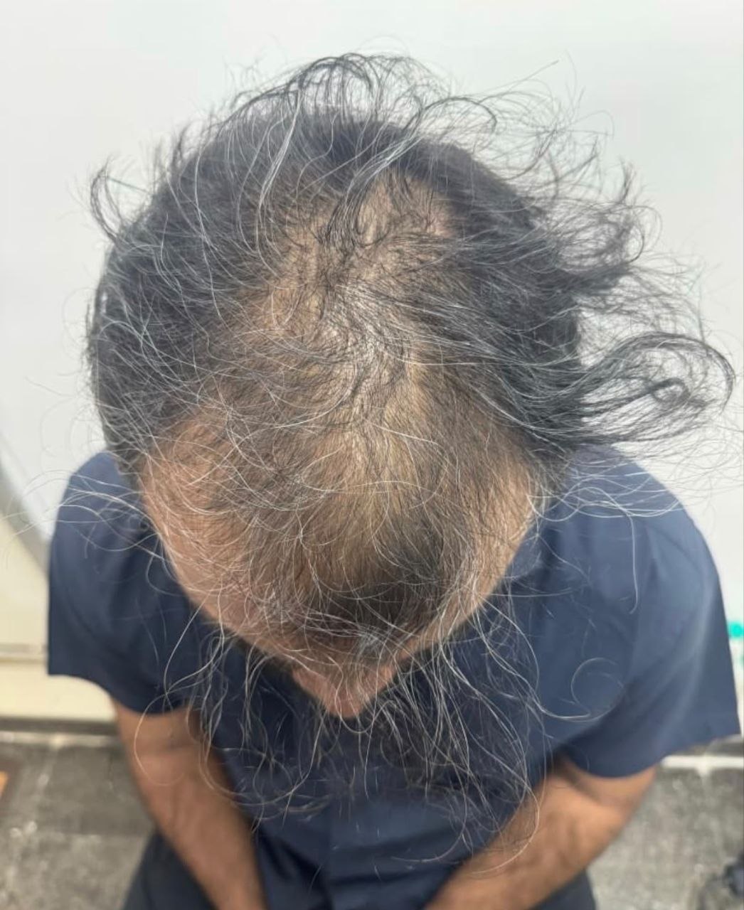 Hair restoration before treatment