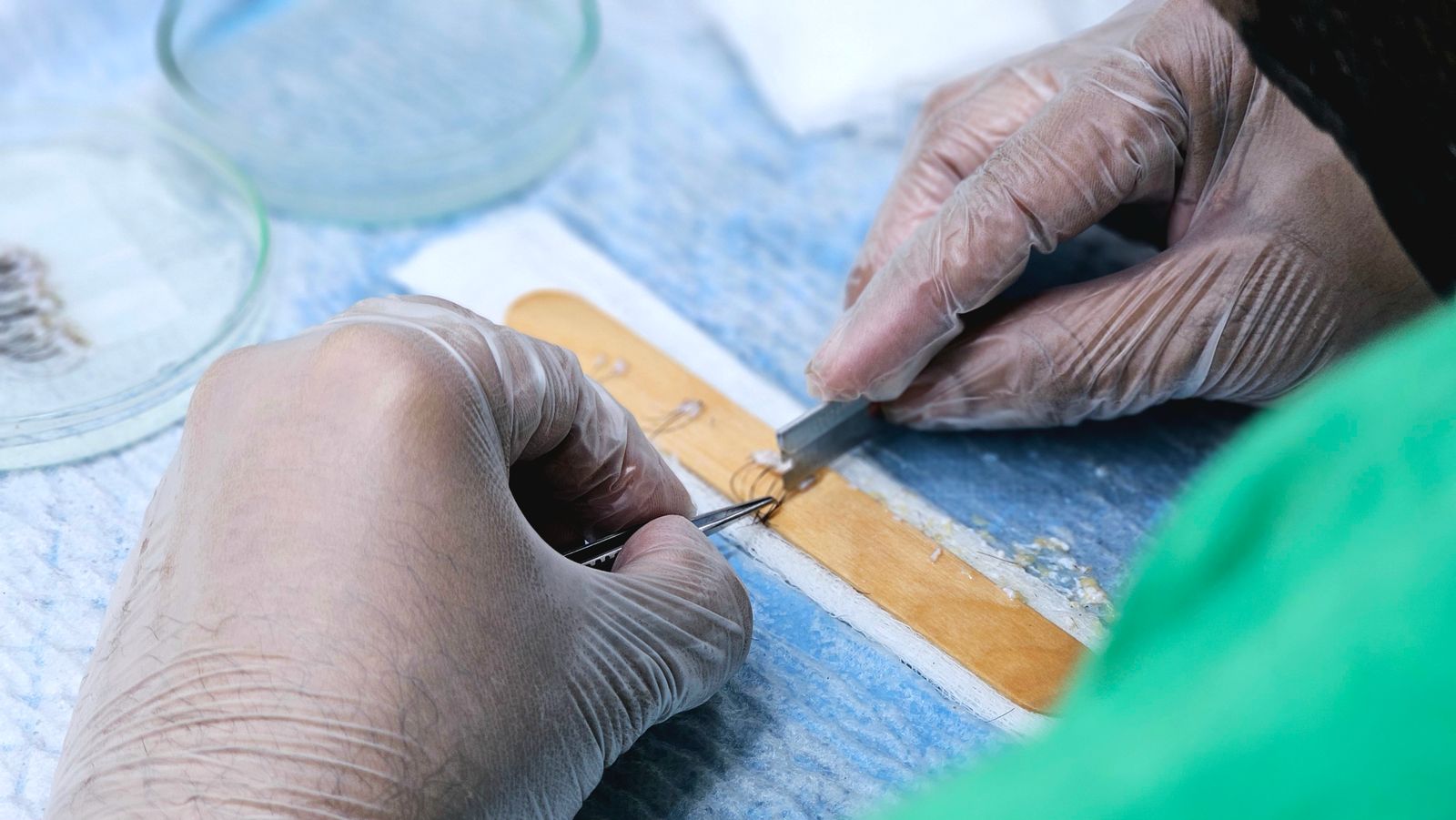 Specialist preparing hair grafts for transplantation